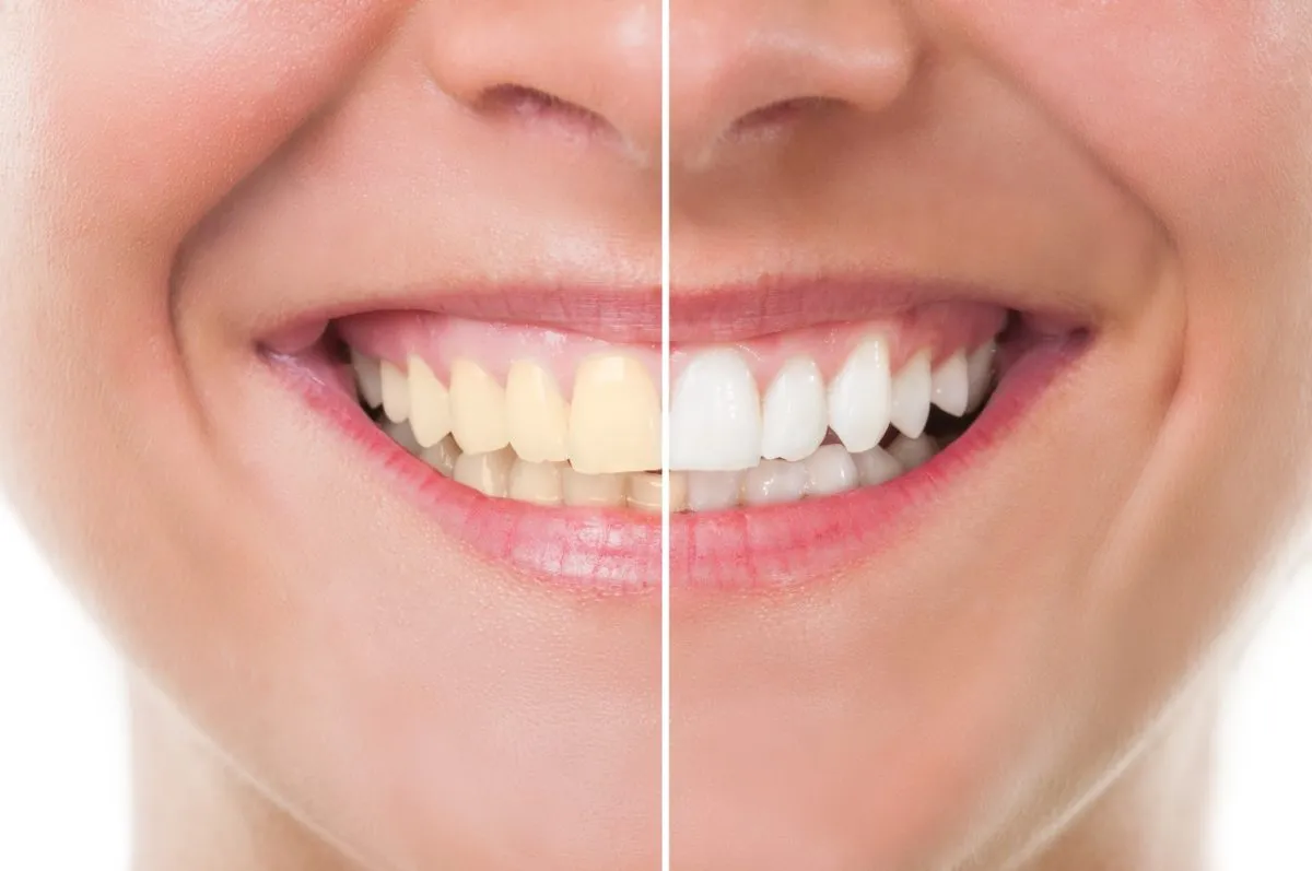 Best Teeth Whitening Treatment in Gurgaon Sector 80